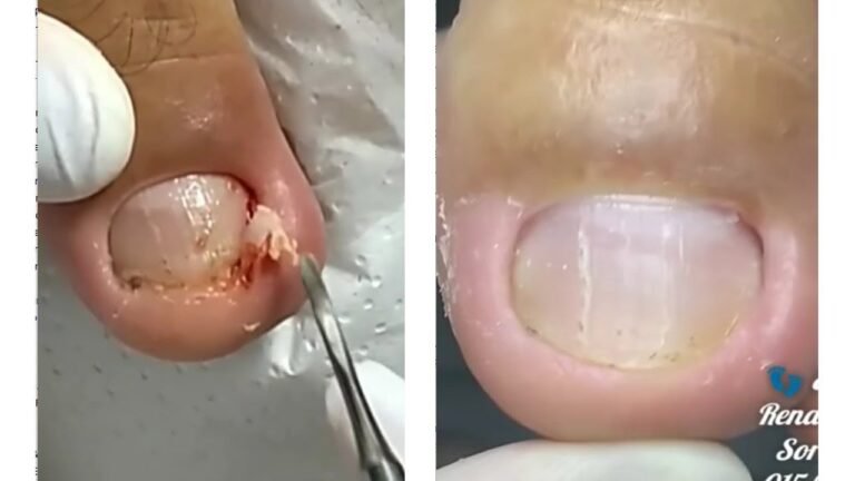 Transformação da Cirurgia de Unha Encravada: Antes e Depois