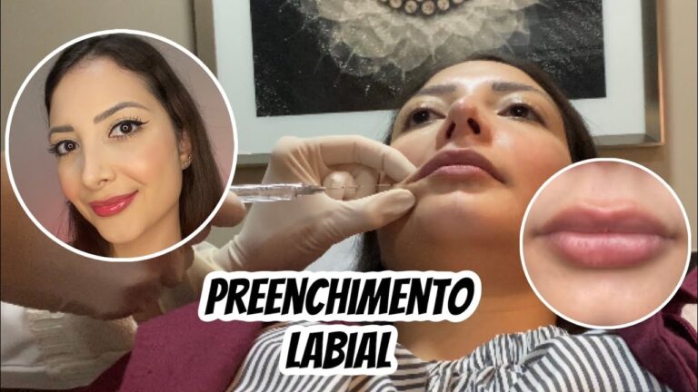 Preenchimento Labial: Valor e Duração dos Resultados