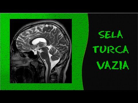 RNM da Sela Turcica: Abordagem Diagnóstica e Relevância Clínica