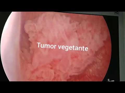 Lesão Vegetante na Bexiga: Entenda a Relação com o Câncer
