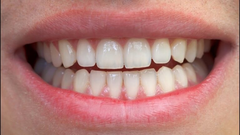 Transformações com Prótese Dentária de Silicone: Antes e Depois
