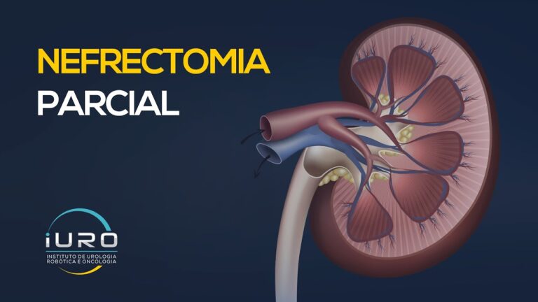Avanços na Nefrectomia Parcial Laparoscópica Unilateral
