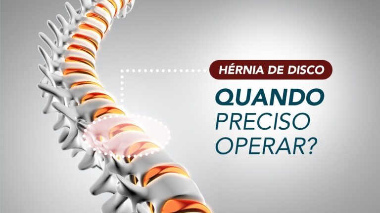 Cirurgia Eficaz para Hérnia de Disco Lombar L4 e L5