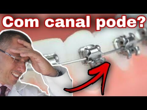 Dente com Canal: Dor ao Usar Aparelho Ortodôntico