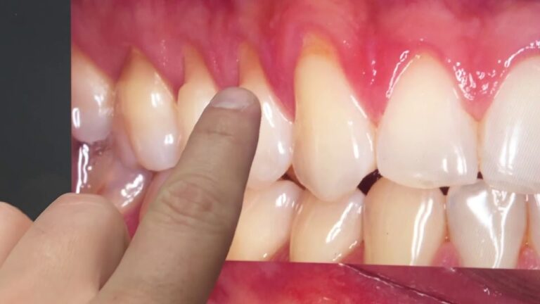 Dor na Raiz do Dente Exposta: Causas e Solu&ccedil;&otilde;es