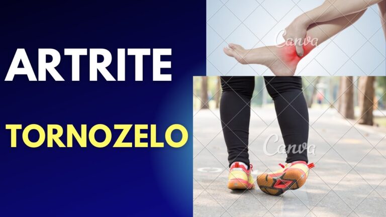 Sintomas da Artrite no Tornozelo: O Que Você Precisa Saber