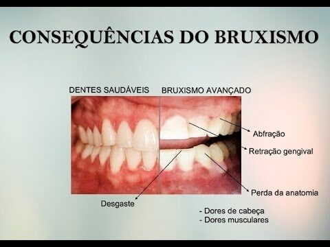 Consequências do Bruxismo: Impactos na Saúde Bucal e Bem-Estar