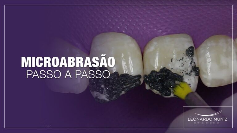 Transformações da Microabrasão: Antes e Depois