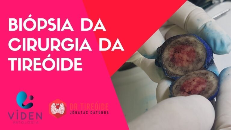 Biópsia da Tireoide: Importância Pós-Cirurgia