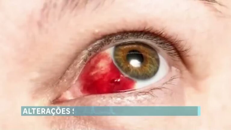 Como Tratar o Derrame Ocular Eficazmente