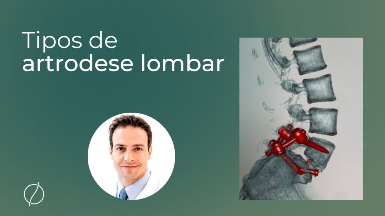 Artrodese Lombar Posterior: Indicações e Benefícios