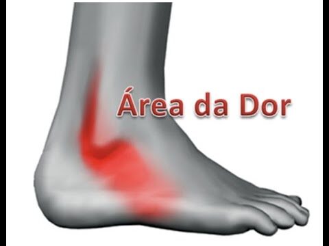 Tendinopatia dos Fibulares: Possibilidades de Cura