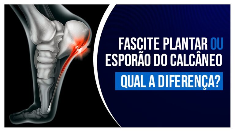 Fascite Plantar e Esporão: Entenda a Relação