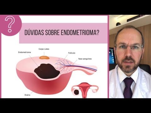 Endometrioma no Ovário: Possibilidades de Cura