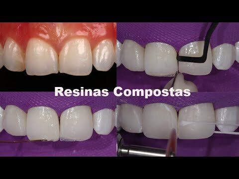 Reconstrução Dental com Resina: Solução Eficiente e Estética