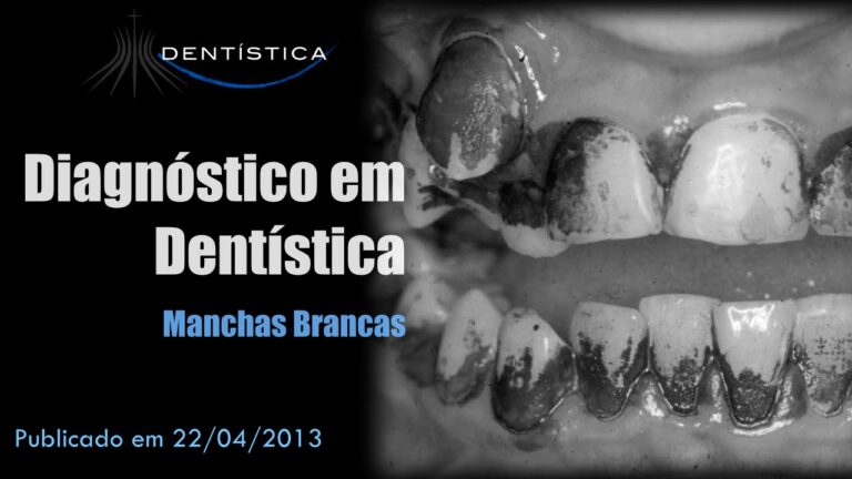 Entendendo a Mancha Branca no Raio X Dental