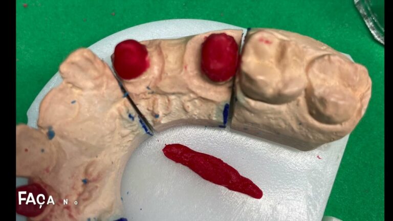 Vantagens da Prótese Dentária Metálica
