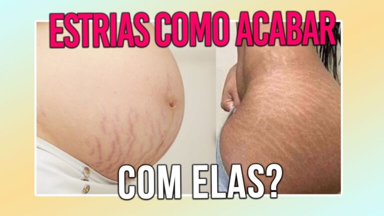 Causas e Tratamentos para Estrias na Parte Íntima