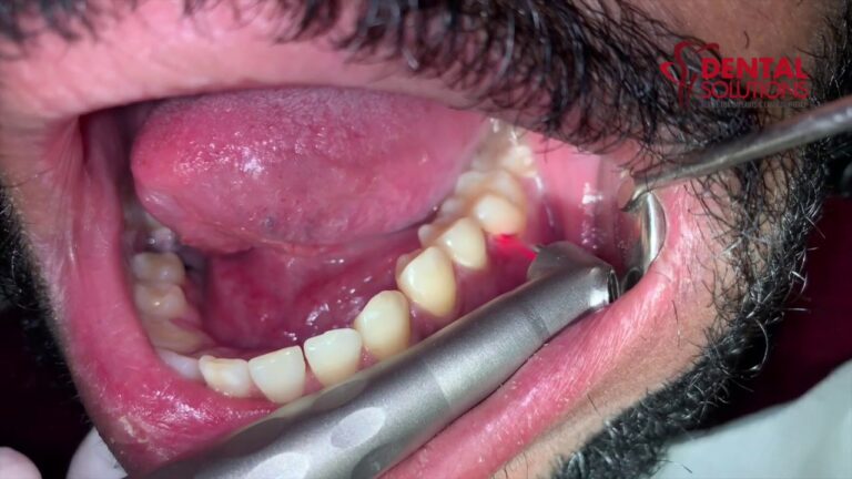 Causas e Tratamentos da C&aacute;rie Cervical