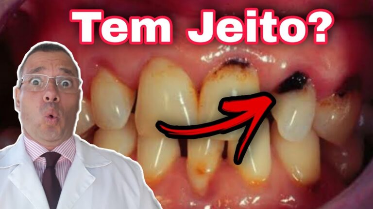 Causas e Tratamentos para Dente Cariado na Raiz