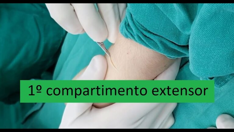 Cirurgia para Tenossinovite de De Quervain: O Que Você Precisa Saber