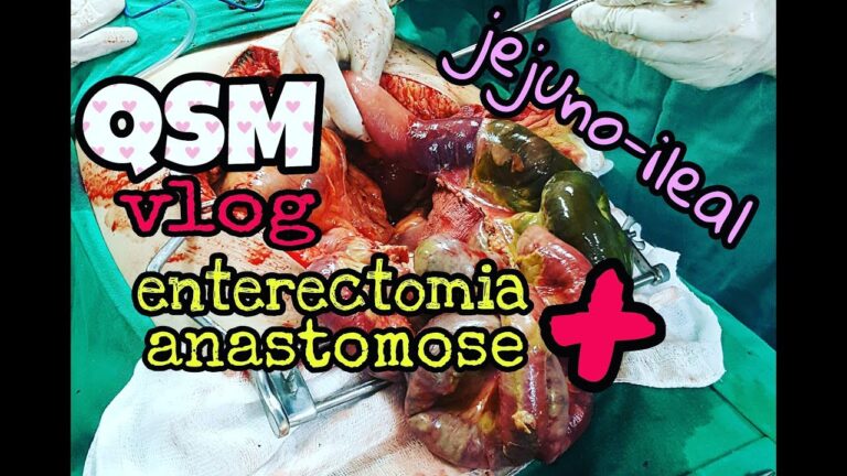 Cirurgia para Remoção de Fezes Intestinais
