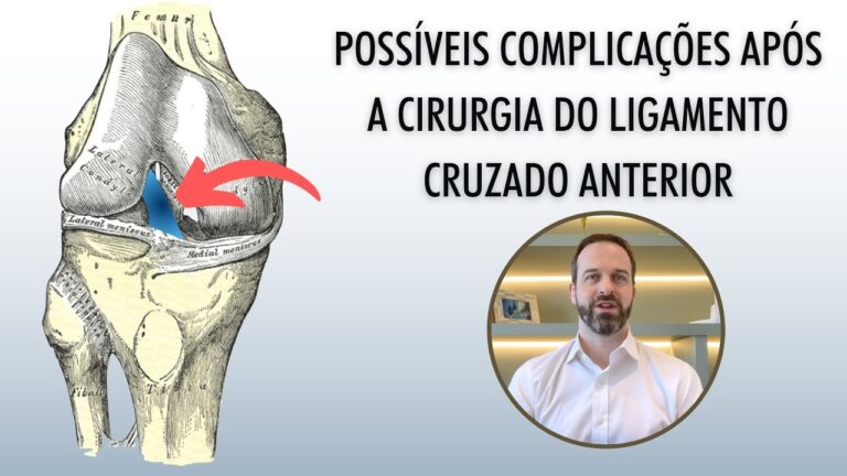 Entendendo a Cirurgia de Ligamento do Joelho: Passo a Passo