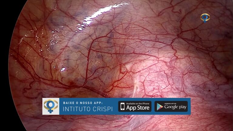 Cirurgia para Endometriose Peritoneal: Abordagens e Resultados