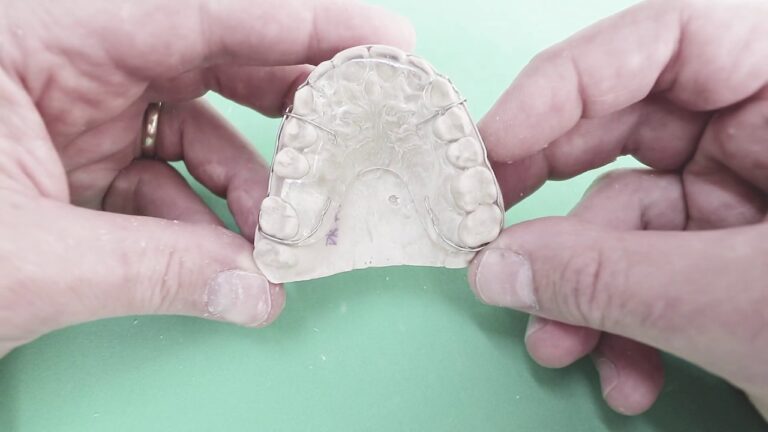 Aparelho Móvel: A Solução Eficaz para Fechar os Dentes