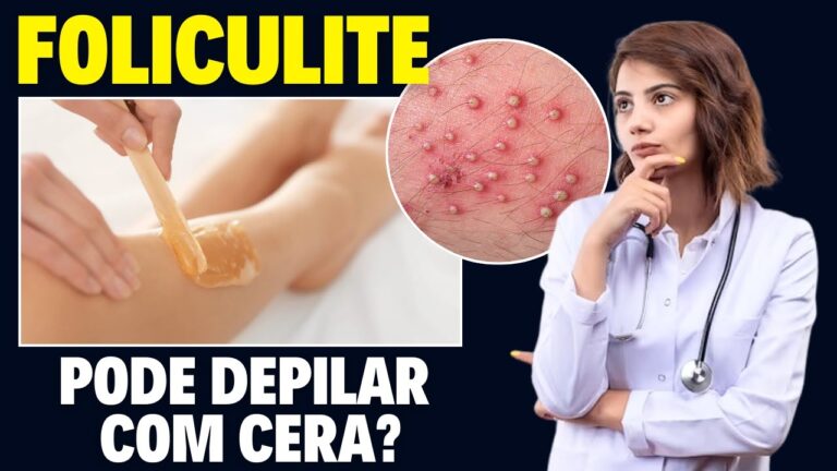 Depilação com Cera para Quem Tem Foliculite: O Que Saber