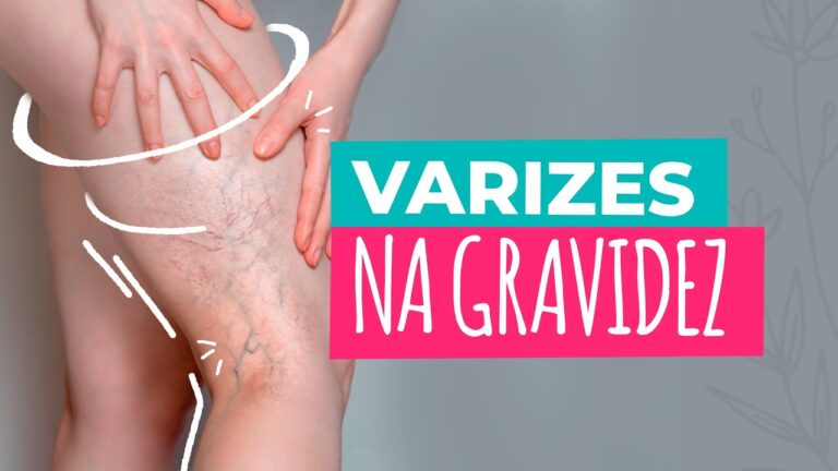 Dicas para Evitar Varizes na Gravidez