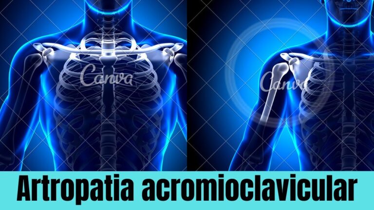 Artropatia Acromioclavicular: Possibilidades de Cura