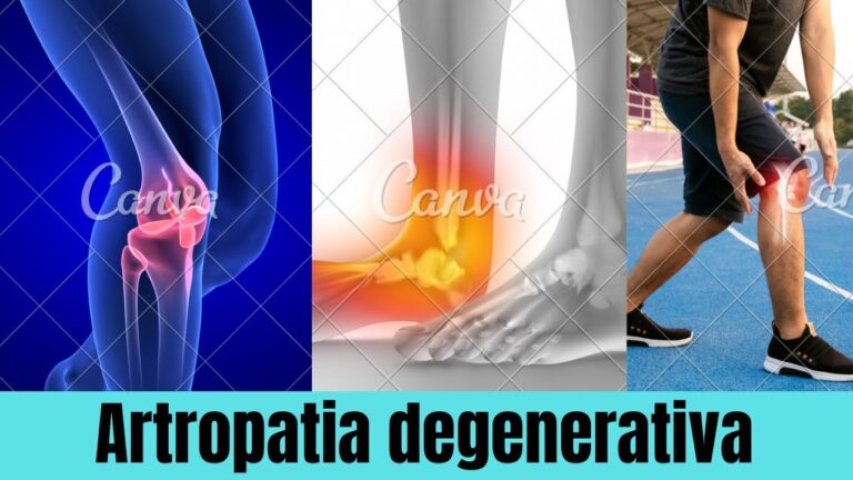 Entendendo a Artropatia Degenerativa: Defini&ccedil;&atilde;o e Implica&ccedil;&otilde;es