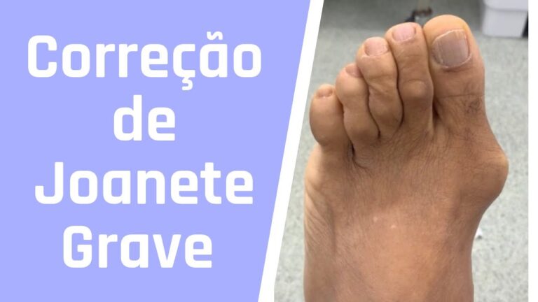 Preço da Cirurgia de Joanete: O Que Você Precisa Saber