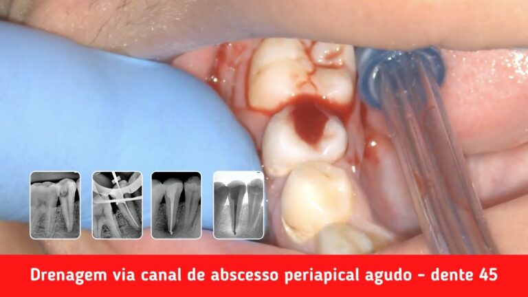 Drenagem Eficiente em Tratamento Odontológico