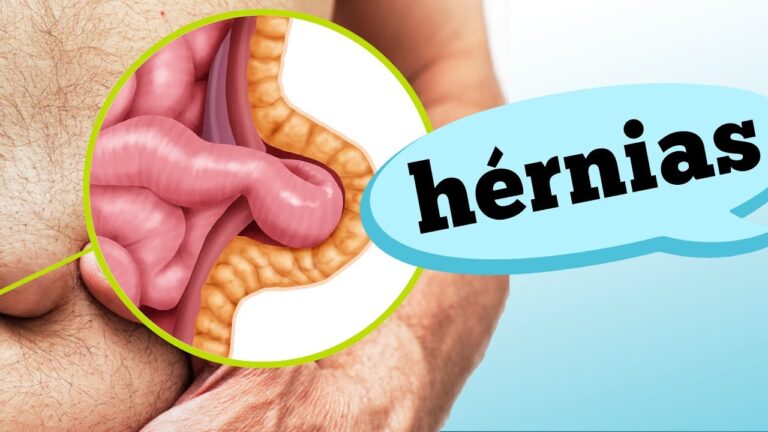 Tipos de Hérnias: Um Guia Completo
