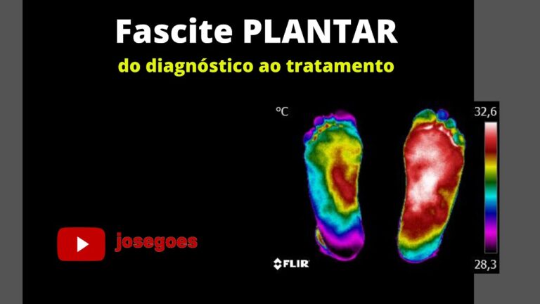 Tratamento Eficaz para Fascite Plantar: Rx e Solu&ccedil;&otilde;es