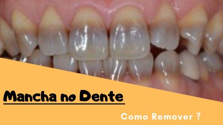Dicas Eficazes Para Remover Manchas Nos Dentes