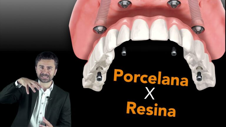 O Melhor Dente para Implante: Guia Completo
