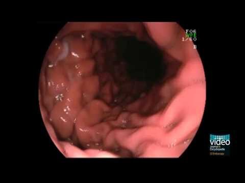 Classificação de Hill na Endoscopia: Uma Abordagem Esclarecedora