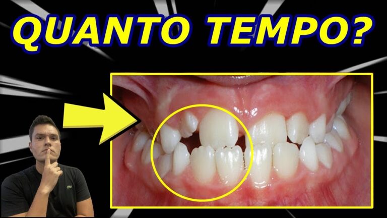 Mordida Cruzada: Tempo Necessário de Aparelho