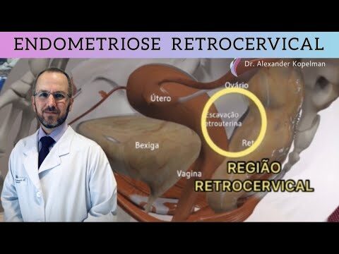Sintomas da Endometriose Retrocervical: O que Você Precisa Saber