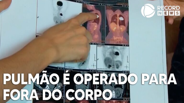 Duração da Cirurgia de Pulmão: O Que Esperar