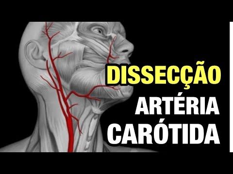 Sintomas das Carótidas: Sinais de Alerta para a Saúde Cerebral