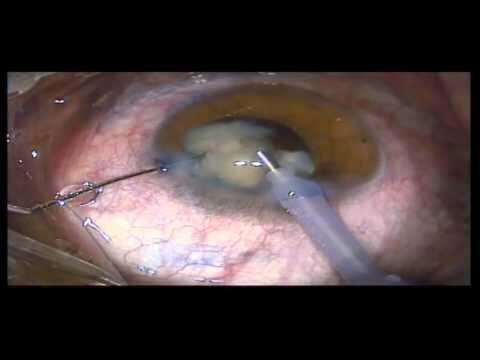 Catarata Traumatica: Causas, Sintomas e Tratamentos