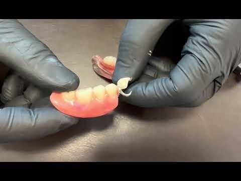 Vantagens da Pr&oacute;tese Dent&aacute;ria Remov&iacute;vel com Grampo