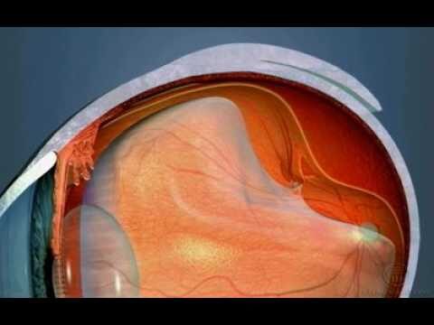 Rasgo na Retina: Possibilidades de Cura
