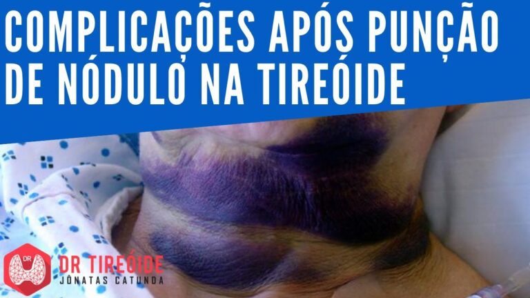 Sintomas Comuns Após a Punção da Tireoide