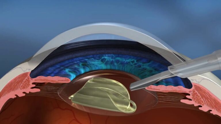 Cirurgia de Catarata a Laser: Como Funciona?