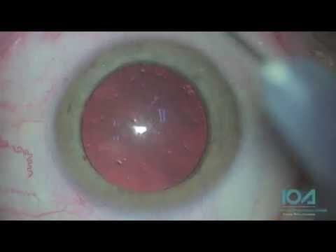 Facectomia com Implante de LIO: Custos e Benefícios